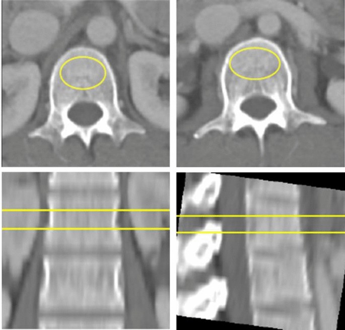 bone density machine